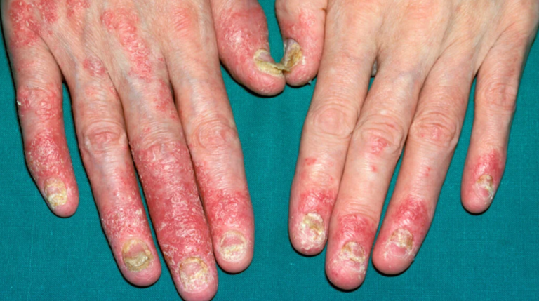 Close-up of both hands with red scaly plaques over the finger joints and thickened, pitted nails, features of psoriatic arthritis