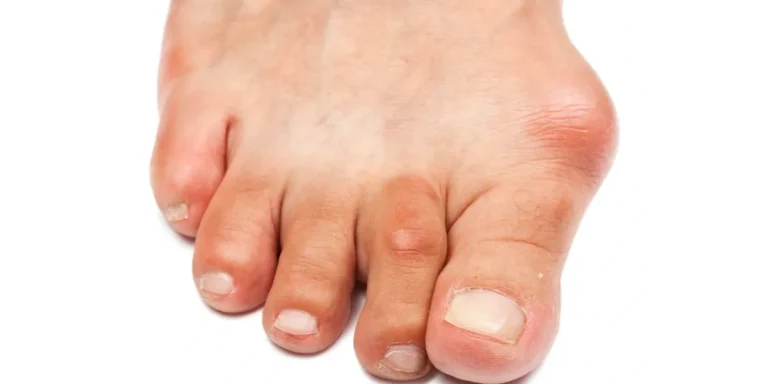 Close-up of a bare foot with redness and swelling at the base of the big toe, the joint most often affected by gout