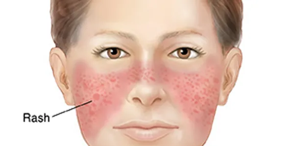 Illustration of a face with a red butterfly-shaped rash across the cheeks and nose, the malar rash of lupus