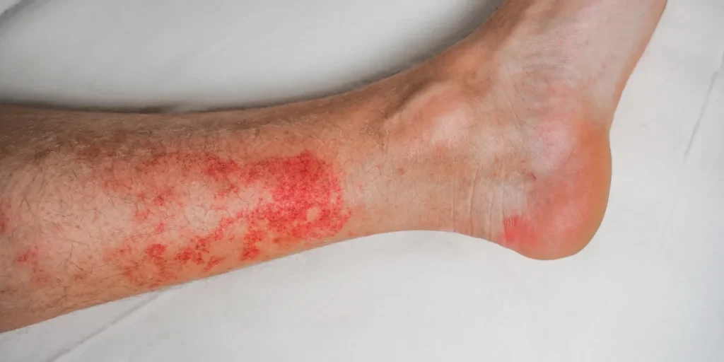 Close-up of a lower leg and ankle with a blotchy red-purple skin rash, a sign of small-vessel vasculitis